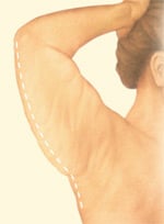 arm-brachioplasty