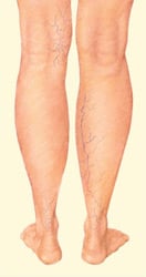 spider_veins-2