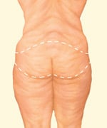 Body Contouring - body lift