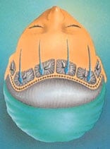 brow_lift-3