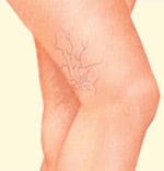 spider_veins-1