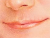injectable_fillers-4