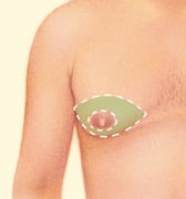 gynecomastia-1
