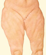 Body Contouring - thighplasty