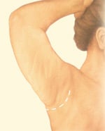 arm-brachioplasty