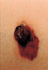 skin_cancer-3