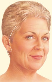 facelift-1