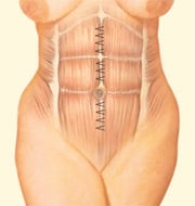 abominoplasty-2
