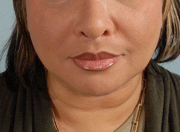 Lip Surgery after