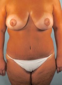 Body Contouring after