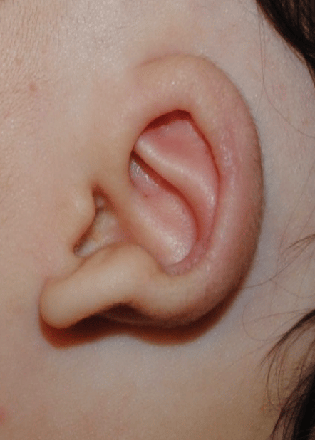 Ear Molding