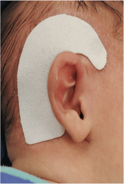 Infant Ear base - EarWell (Ear Mold)