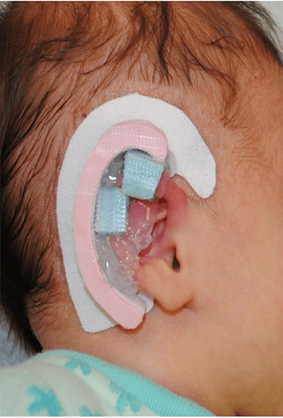 Ear Silicone Gel