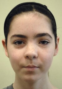 Facial Reconstruction BxA