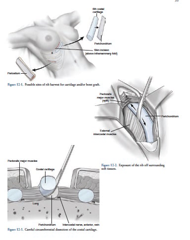 Cartilage Harvesting Cartilage Harvesting