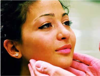 Chin Implant