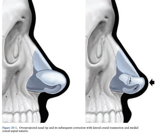 Decreasing Nasal Protection Decreasing Nasal Protection
