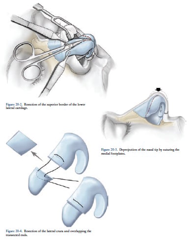 Decreasing Nasal Protection Decreasing Nasal Protection