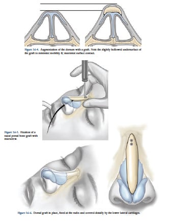 Dorsal Augmentation Dorsal Augmentation
