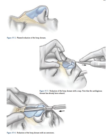 Dorsal Reduction Dorsal Reduction