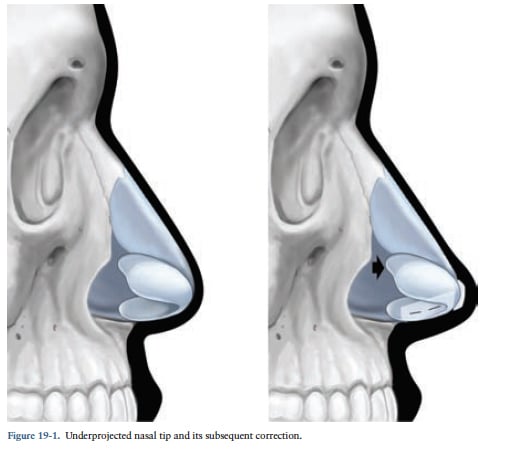 Increasing Nasal Protection Increasing Nasal Protection