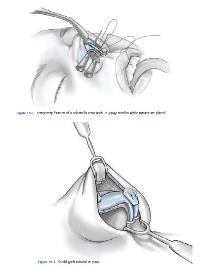 Increasing Nasal Protection Increasing Nasal Protection