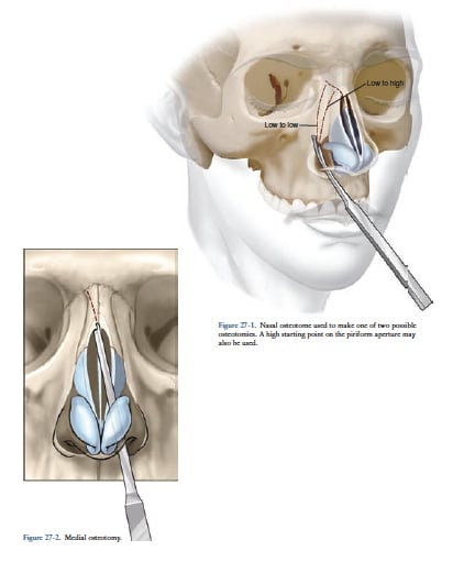 Narrowing the nose Narrowing the nose