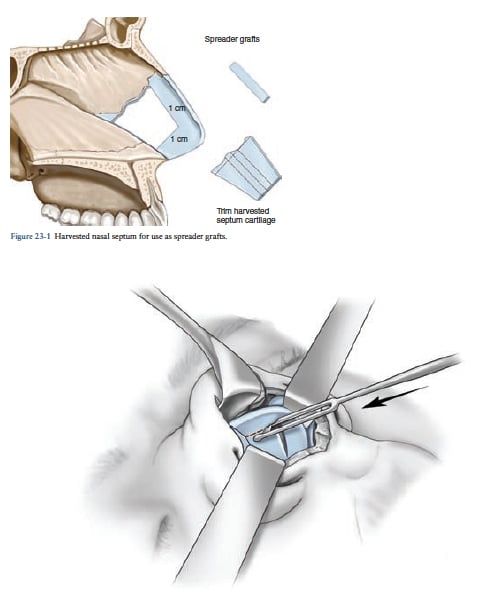Spreader Grafts Spreader Grafts