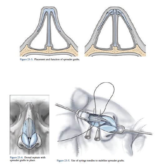 Spreader Grafts Spreader Grafts