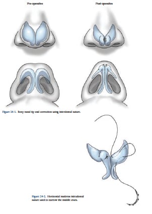 Tip Definition Tip Definition