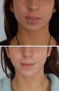 Chin Surgery BxA