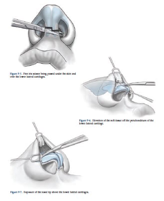 Open Rhinoplasty Open Rhinoplasty