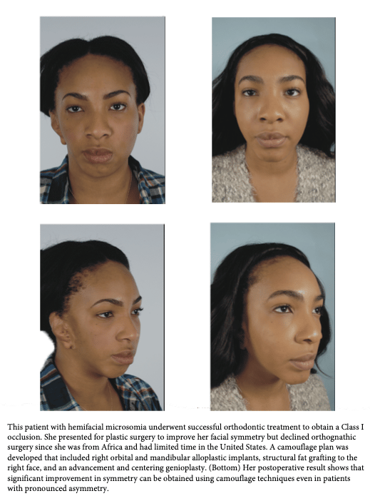 Orthognathic Camouflage Washington DC Before & After Photos